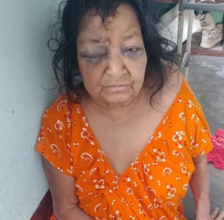 बैसाखीको सहारामा बाँचेकी आमामाथि छोराको अत्याचार, दुई वर्षदेखि दिँदै आएका थिए यातना